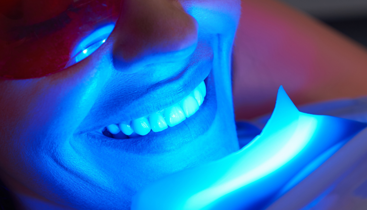 Zobu balināšanas process ar zilo gaismu